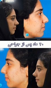 تورم بینی بعد از جراحی _ دکتر سهراب براتی-drsohrabbarati.com