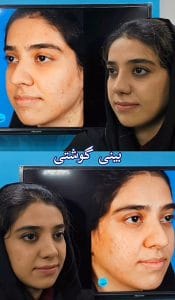 ورم بینی بعد از عمل _ دکتر سهراب براتی-drsohrabbarati.com