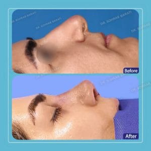 روش ها رفع ورم بینی بعد از عمل _ دکتر سهراب براتی-drsohrabbarati.com
