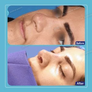 تروم بعد از رینوپلاستی _ دکتر سهراب براتی-drsohrabbarati.com
