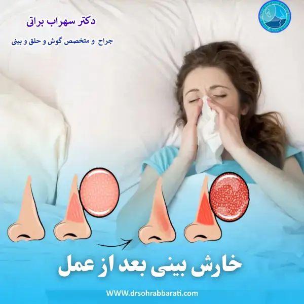 خارش بینی بعد از عمل _ دکتر سهراب براتی