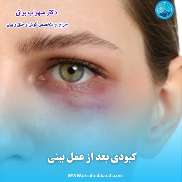 کبودی بعد از عمل بینی _ دکتر سهراب براتی