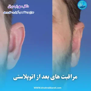 مراقبت های بعد از جراحی گوش _ دکتر سهراب براتی