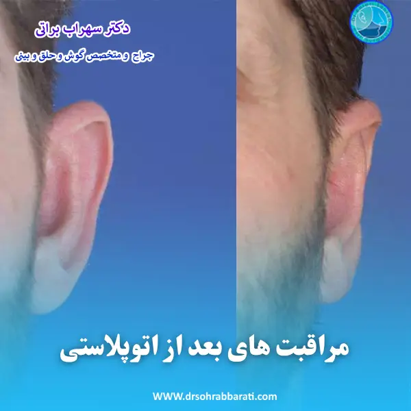مراقبت های بعد از جراحی گوش _ دکتر سهراب براتی